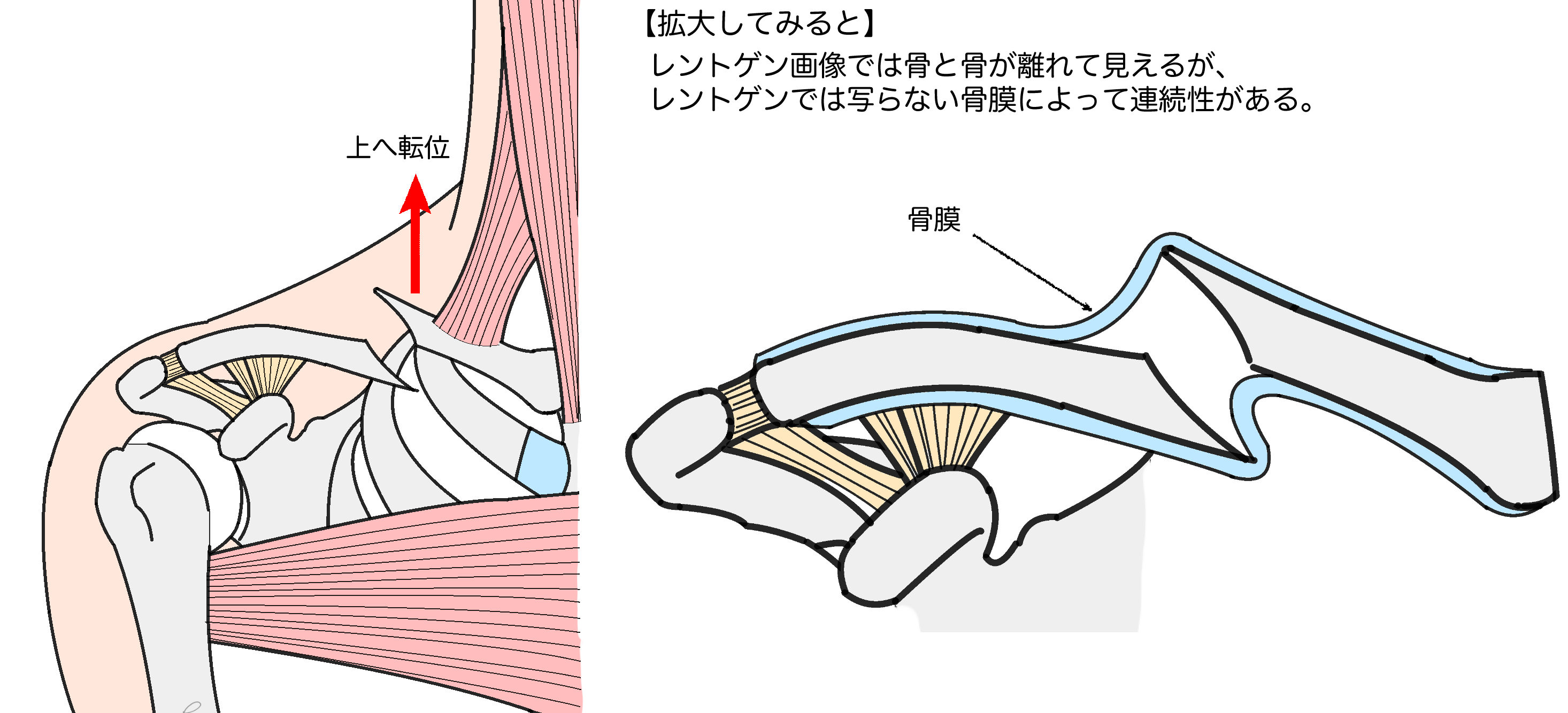 50 子供 鎖骨 骨折 かわいい子供たちの画像